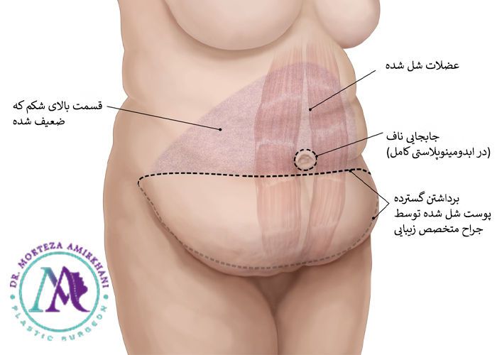 جراحی شکم به روش ابدومینوپلاستی