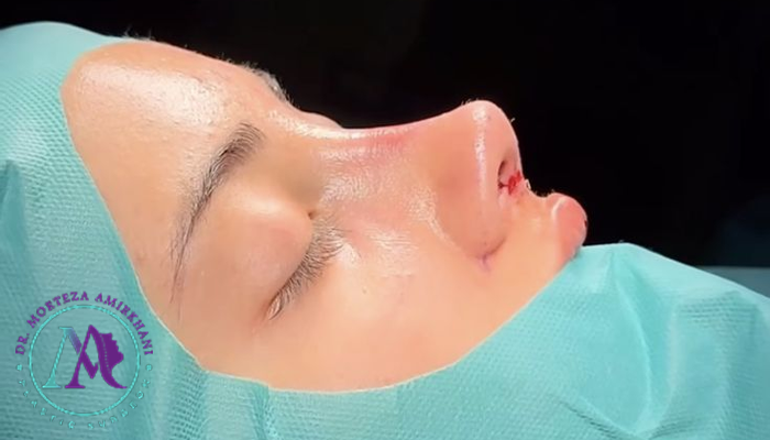 دوره نقاهت عمل بینی چقدره
