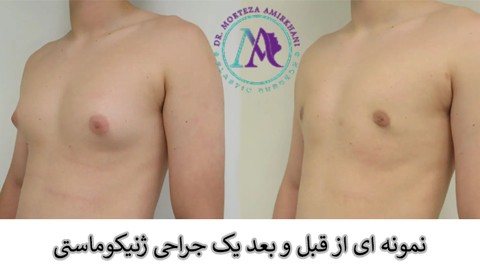 عکس قبل و بعد ژنیکوماستی