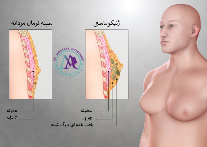 عکس ژنیکوماستی و سینه طبیعی مردانه