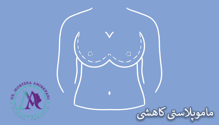 ماموپلاستی کاهشی