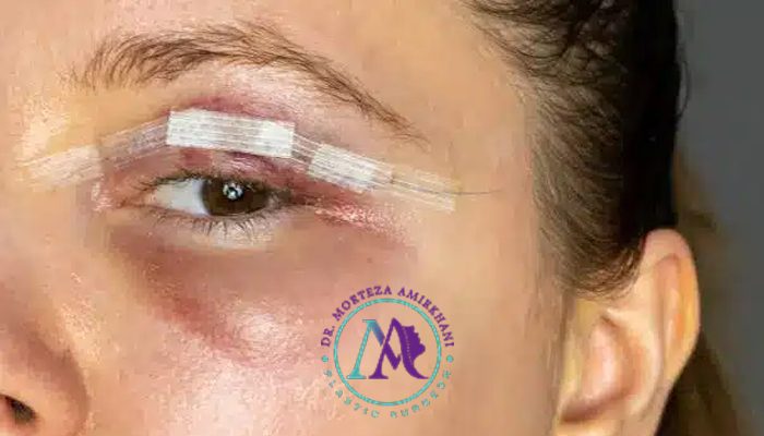 عکس بعد جراحی زیبایی پلک