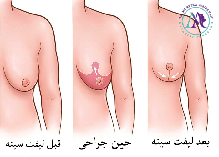 نتایح لیفت سینه در قم