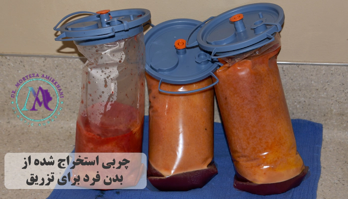 استخراج چربی از بدن و سپس تزریق آن