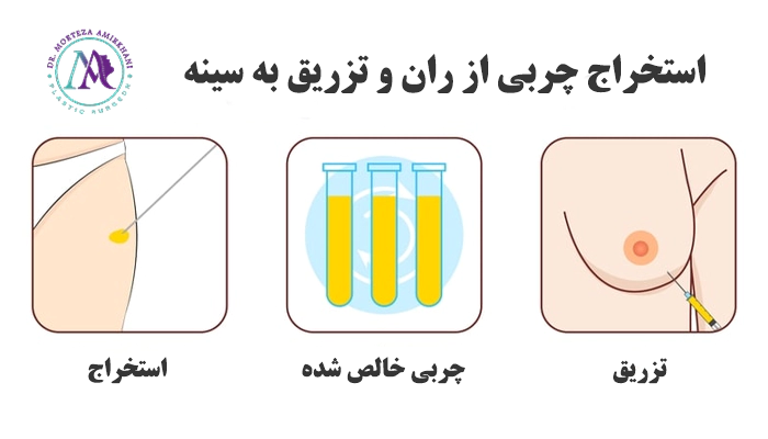 تزریق چربی به سینه در قم