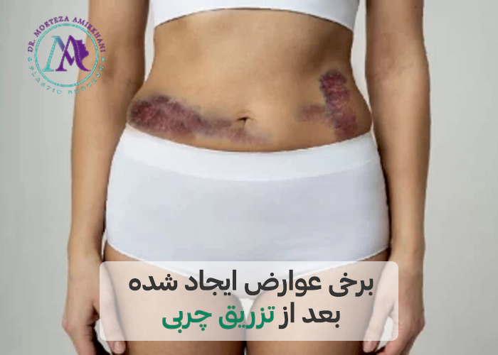 عوارض تزریق چربی به صورت و بدن