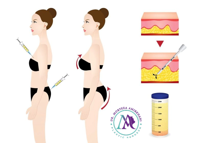 نتایج تزریق چربی