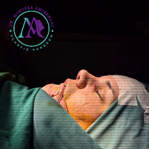 نمونه کار جراحی بینی دکتر امیرخانی