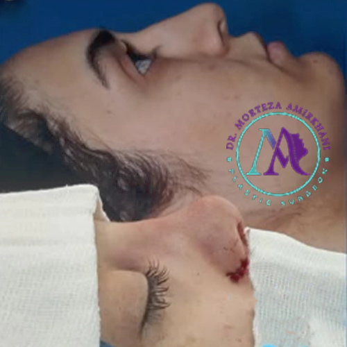 نمونه کار جراحی بینی دکتر امیرخانی2