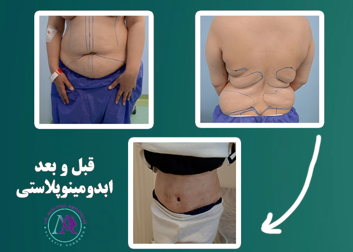 نمونه کار قبل و بعد از ابدومینوپلاستی توسط بهترین جراح شکم
