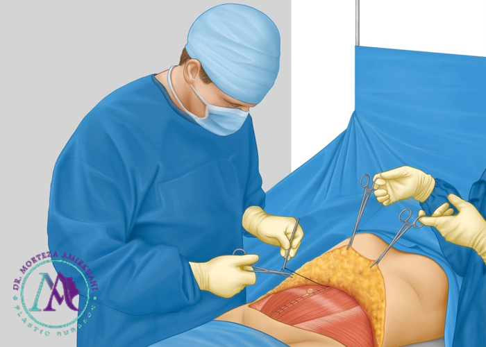چگونه بهترین جراح زیبایی شکم در قم را پیدا کنیم؟