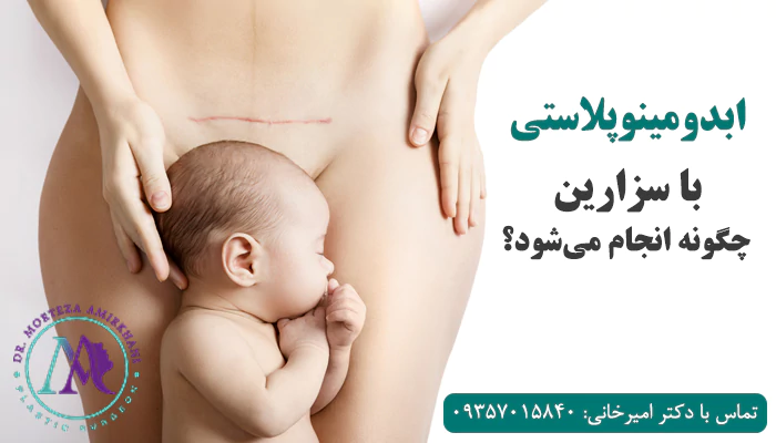 ابدومینوپلاستی با سزارین چگونه انجام میشود؟