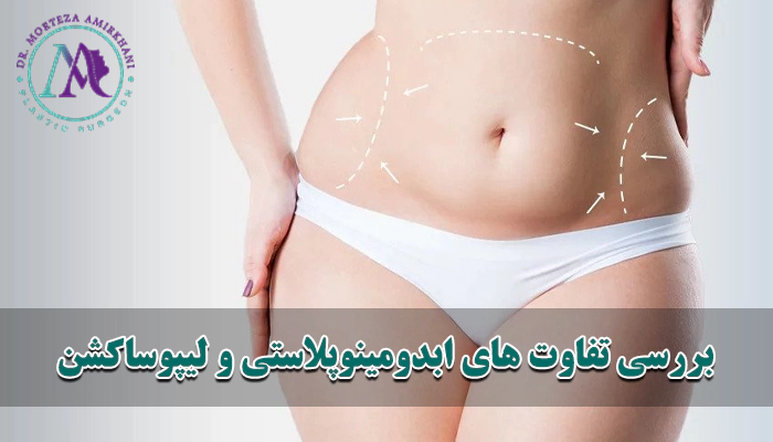 ابدومینوپلاستی و لیپوساکشن چه تفاوت هایی باهم دارند؟