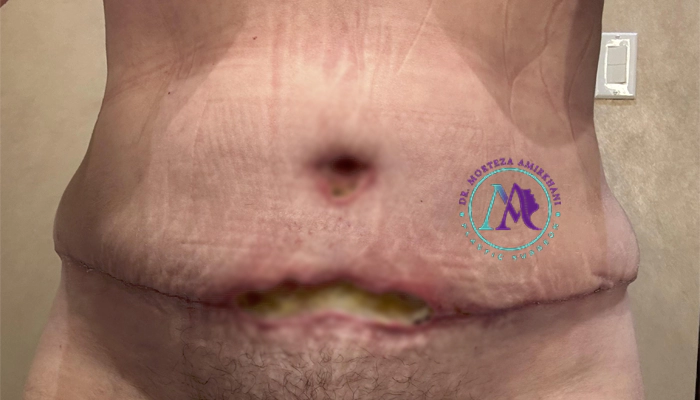 عوارض نادر و کمیاب ابدومینوپلاستی